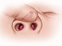 Burunda Kıkırdak Erimesi Belirtileri ve Tedavisi