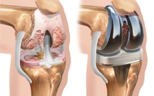 Dizde Kıkırdak Erimesi Belirtileri ve Tedavisi