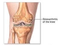 Kıkırdak Aşınması Belirtileri ve Tedavisi